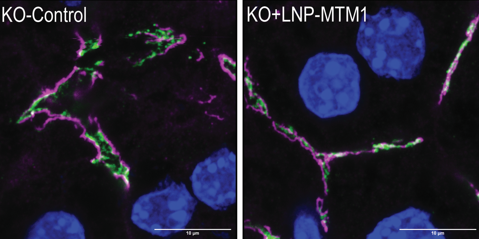 Side-by-side fluorescence micrographs of liver tissue from knockout mice. In KO control mice with cholestasis, bile salt export pump (BSEP, green) and tight junction marker ZO1 (magenta) appear fragmented and disorganized around hepatocytes, with nuclei shown in blue. In KO mice treated with LNP‑MTM1, BSEP and ZO1 show more continuous, linear localization along bile canaliculi, indicating restored junction structure. Scale bar, 10 µm.