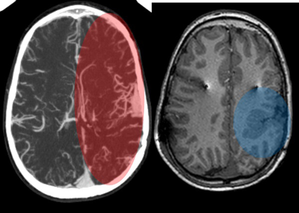 Two brain scans side by side.