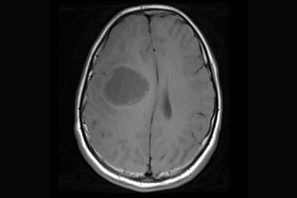 A scan of a brain with priMMRD subtype 2