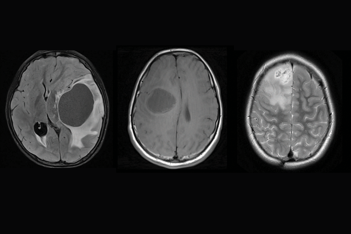 Brain scans showing three different subtypes of priMMRD high-grade glioma.