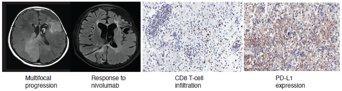 Two images of a brain scan with different areas highlighted beside a two image of cell response to immune check-point inhibitors. Description in caption.