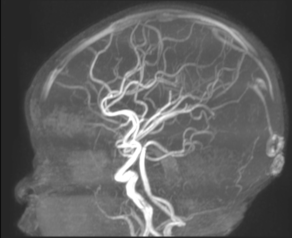Brain angiogram showing detailed cerebral blood vessel structure and vascular pathways in lateral view X-ray imaging.